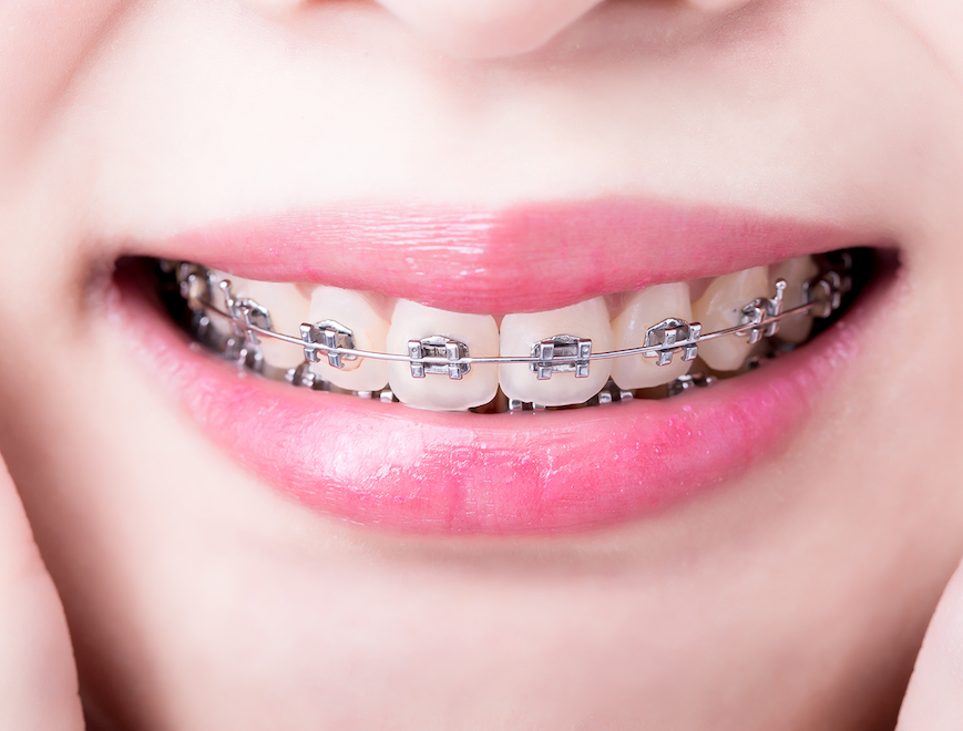 成人矯正のイメージ